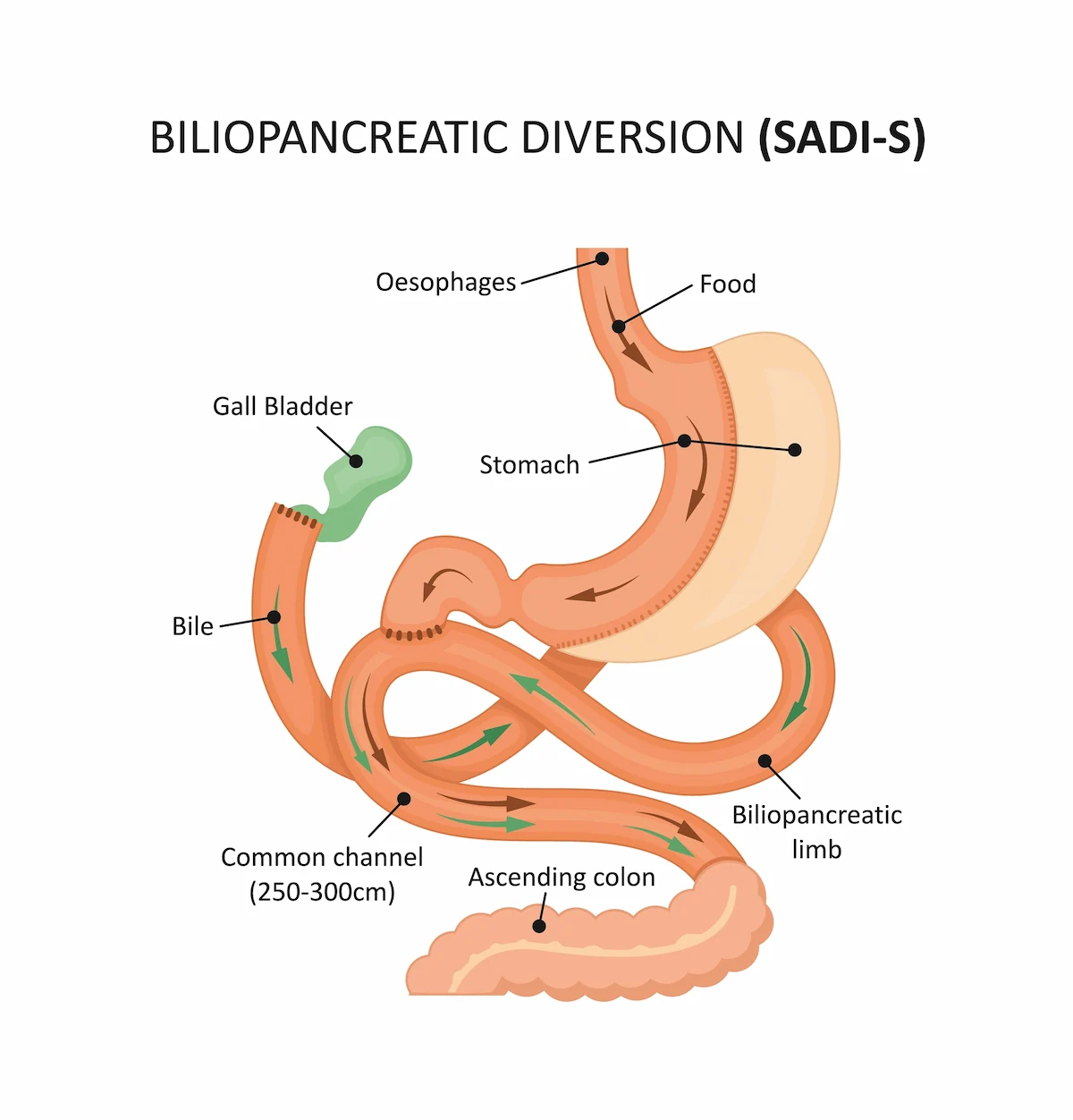 Sadi Duodenal Switch In Seattle Wa Duodenal Switch Everett Pnw 1638